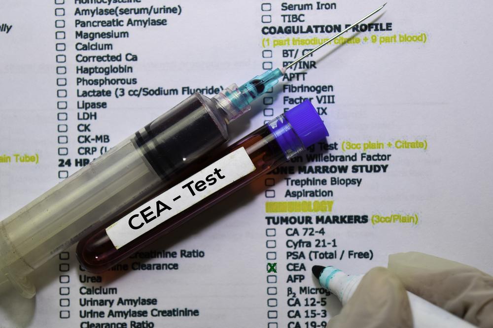 CEA - Test with blood sample. Top view isolated on office desk. Healthcare/Medical concept