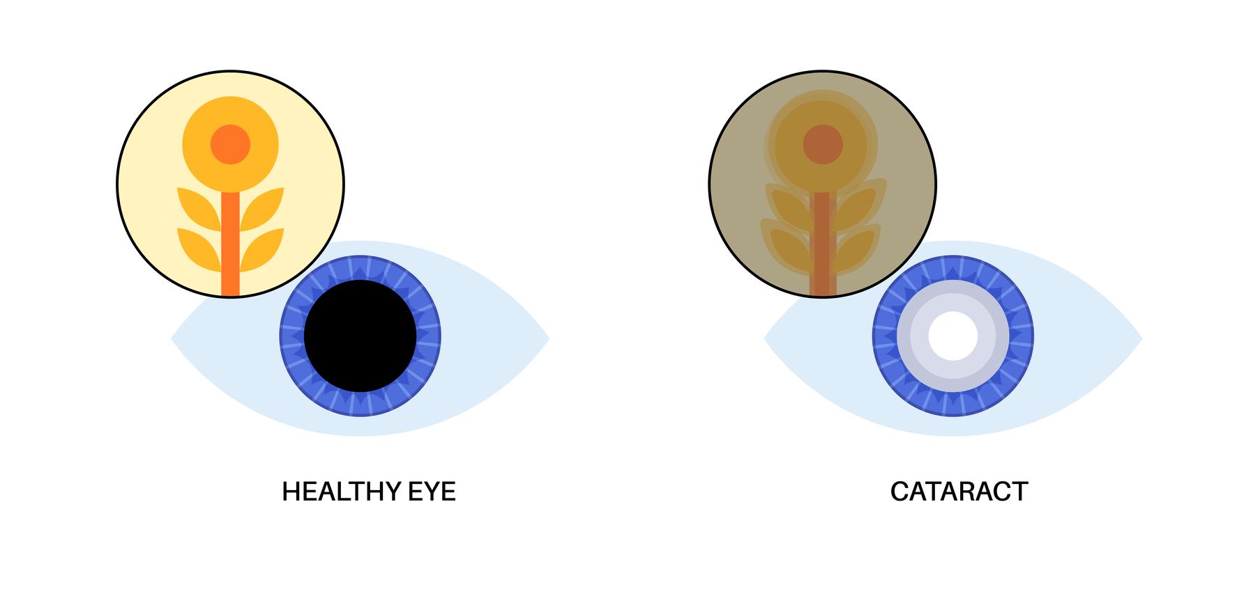 Cataract by TCMchef Raphael