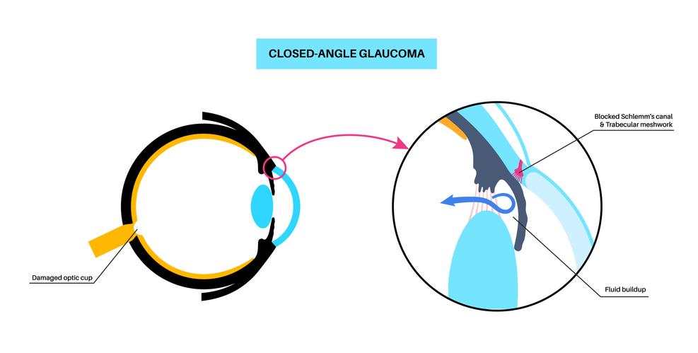 Glaucoma explained by TCMchef Raphael